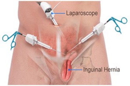 Ventral Hernia Repair Pasadena Orange County CA