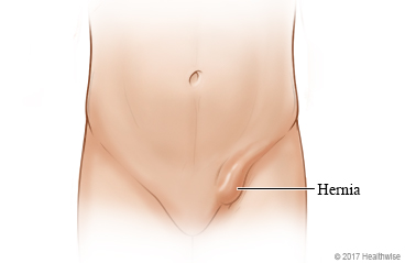 Can A Hernia Have Effects On Your Sex Life